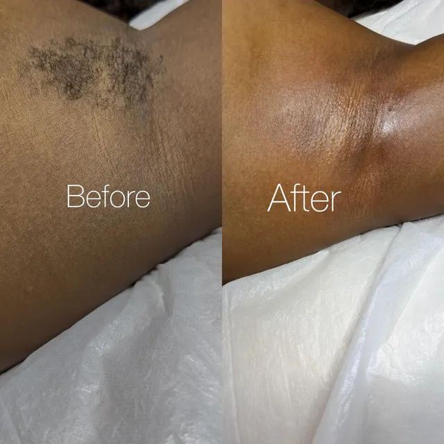 Waxing results at Elite Spa & Aesthetics